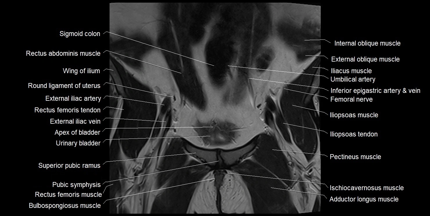 female pelvis coronal cross sectional anatomy image 8.webp